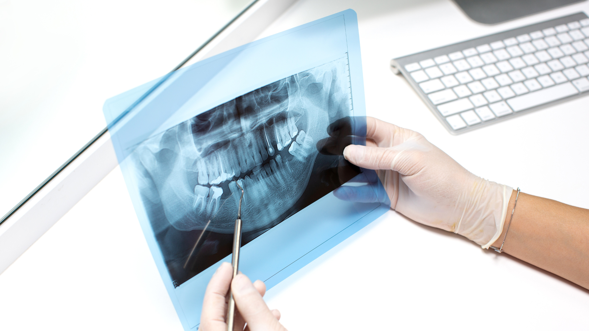 è sempre necessario fare una tac prima di un impianto dentipiù Frosinone